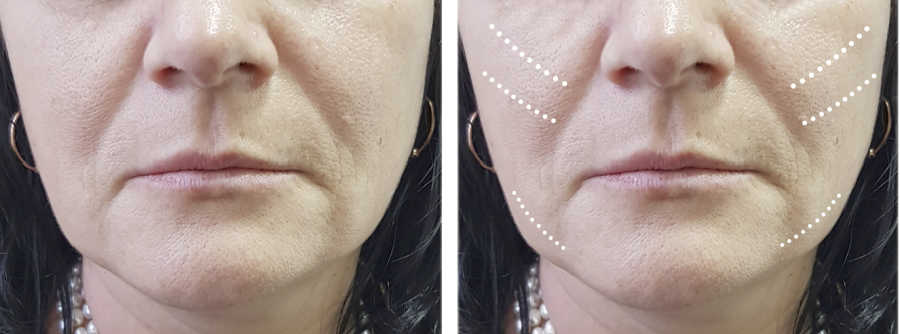 Facial Jowl Exercises Reduce Sagging Jawline Naturally