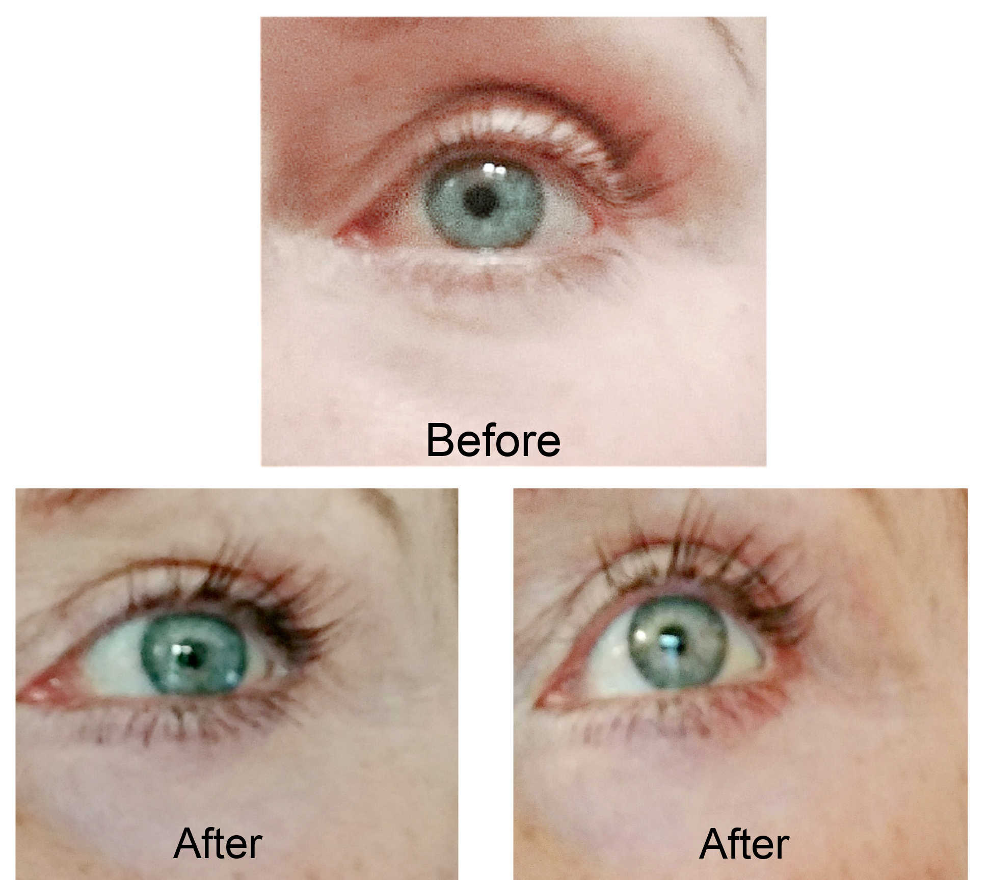 latisse eye color change before and after