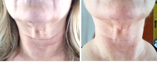 My Neck Firming Results – No Expensive Procedures