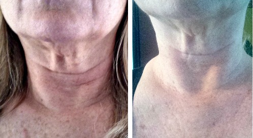 Get Rid of Turkey Neck - See My Results!